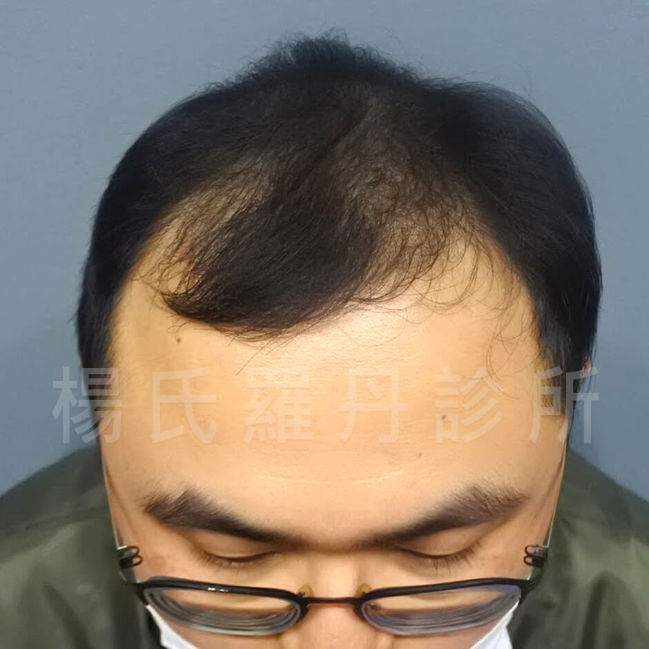 生髮 生髮613 植髮 複合式生髮  掉髮